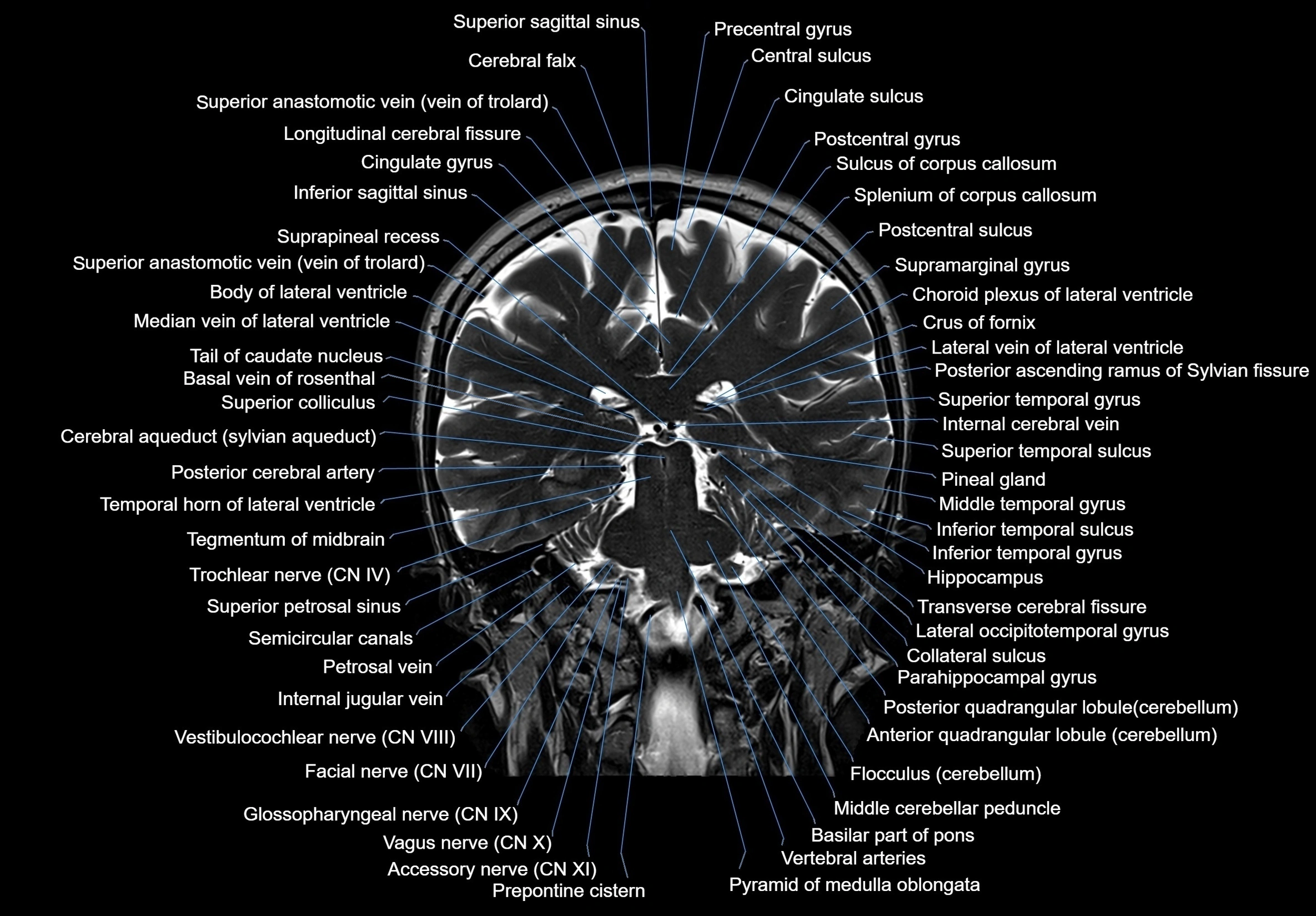 MRI Brain coronal cross sectional labelled anatomy 3T image  -img-00001-00046.webp